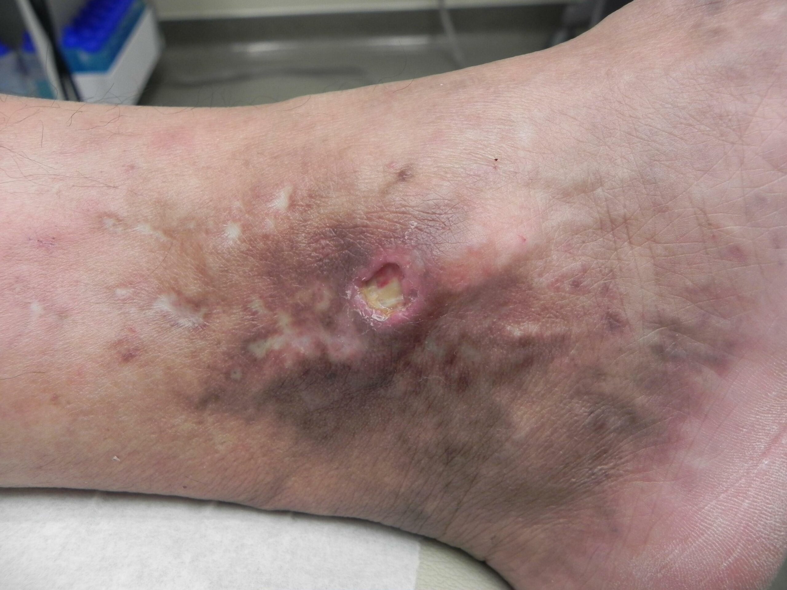 1a_Venous-Statis-Ulcer_Patient1_Before