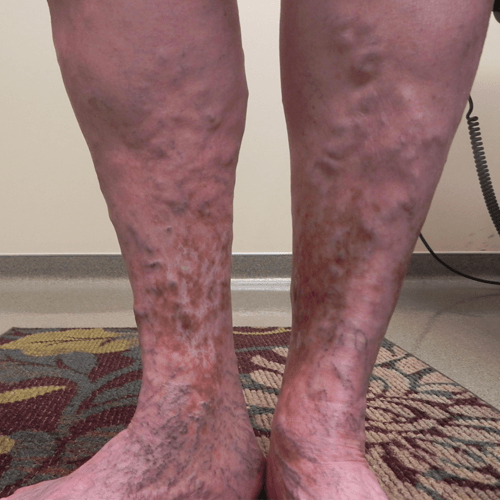 Chronic Venous Insufficiency Patient Photo