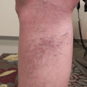 Photo of patient suffering from vein matting in leg; treated at Vein Care Specialists in Wichita, KS.