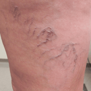 Photo of patient suffering severe spider veins in leg.