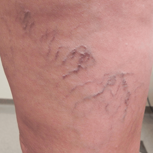 Spider Veins Patient Example VeinCare Specialists