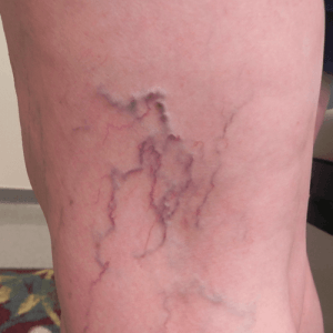 Photo of patient with severe spider veins in leg; treated at VeinCare Specialists