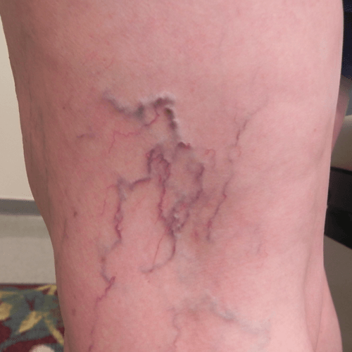 Spider Veins