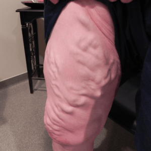 Photo of patient with severe varicose veins in leg; patient treated at Vein Care Specialists.