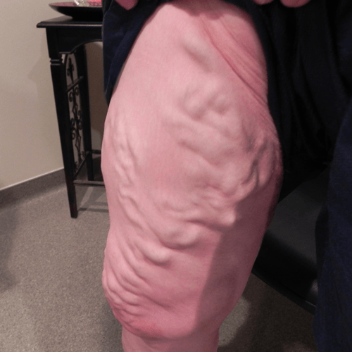 Varicose Veins