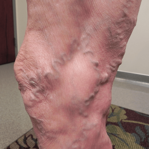 Varicose Veins Patient Example 1