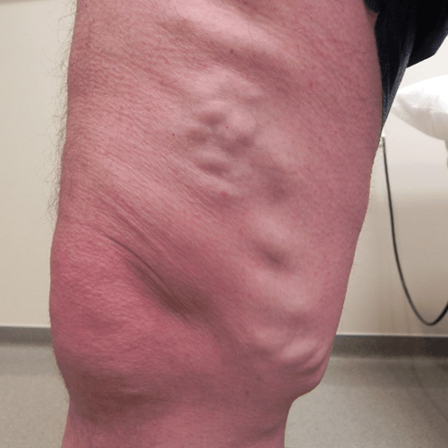 Varicose Veins