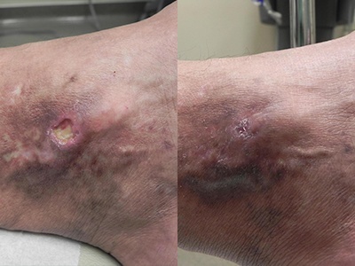 Venous Stasis Ulcer Before & After Photo