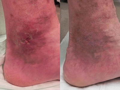 Venous Stasis Ulcer Before & After Photo