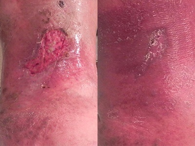 Venous Stasis Ulcer Before & After Photo